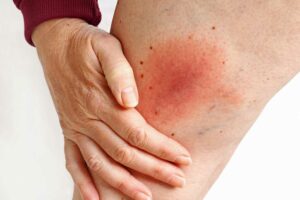 insect bite and stings emergencies