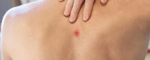 image of back of a man suffering from abscess problem