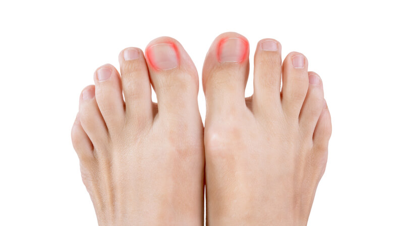 how-to-treat-infected-ingrown-toenail