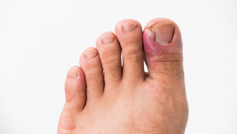 Ingrown on sale infected toenail