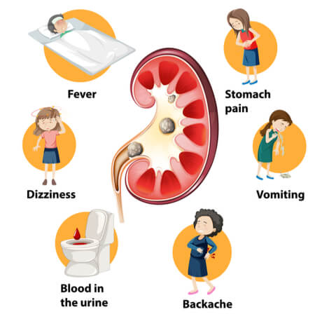 Slow/weak urine flow in the morning - anyone else get this symptom? :  r/KidneyStones