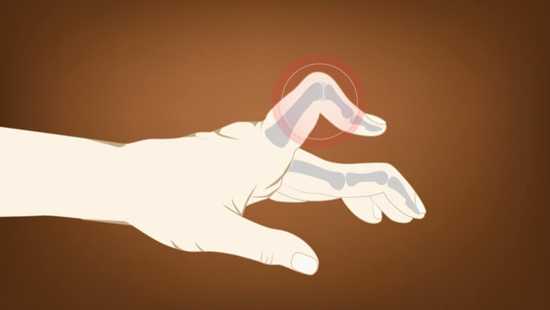 Jammed Fingers: What to Do and When to See a Doctor