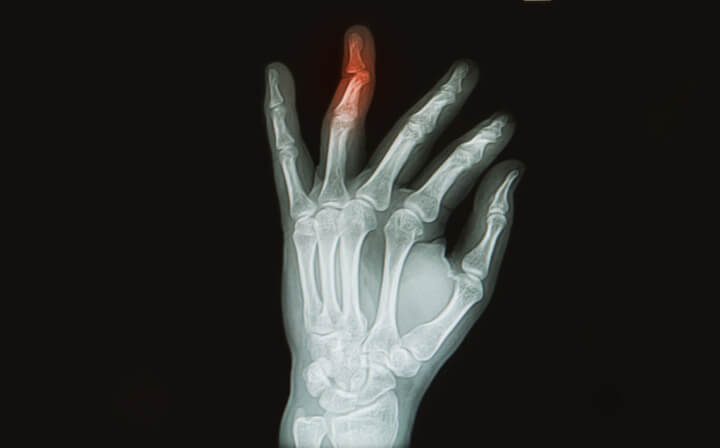 Jammed Fingers: What to Do and When to See a Doctor