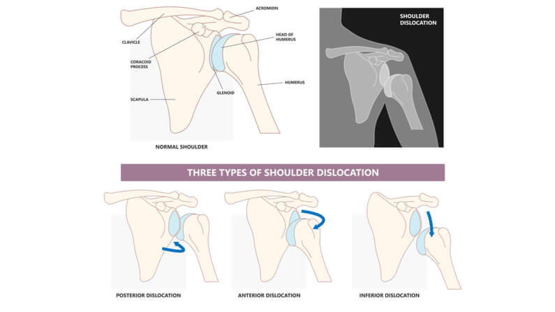 Everything You Need To Know About Shoulder Dislocation