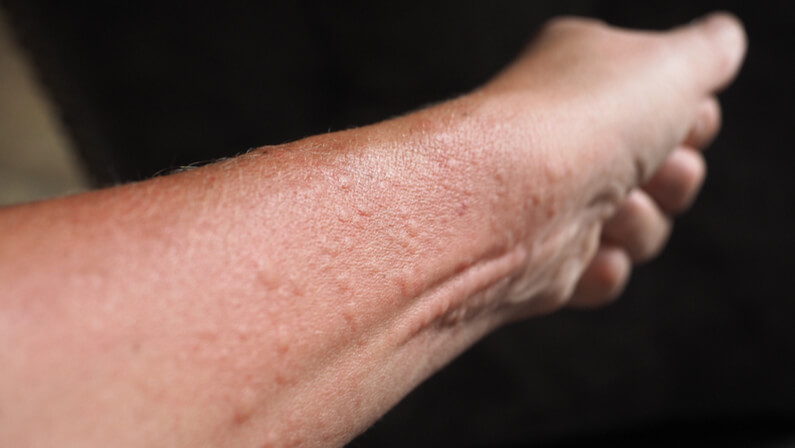 Dermatitis Rash On Hands