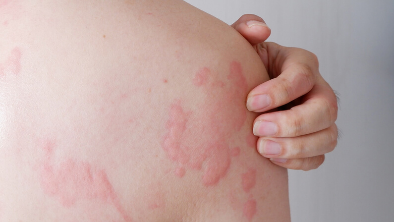 7 Signs a Skin Rash Could Indicate Something Serious