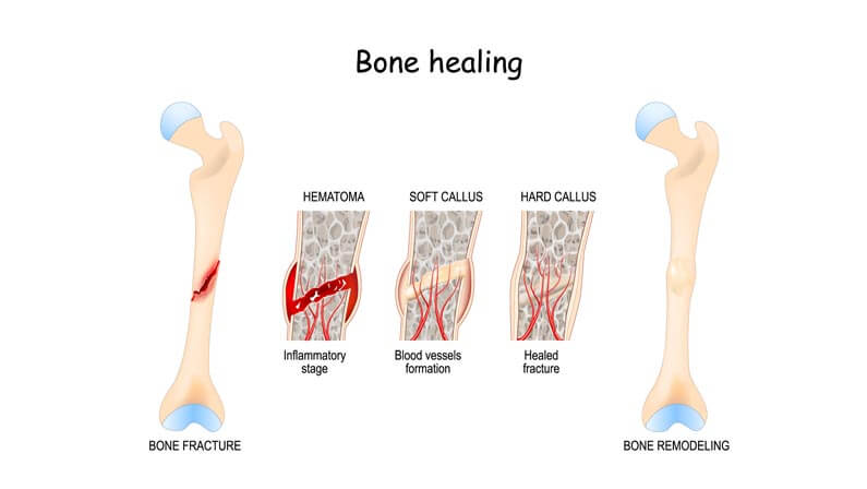 Fracture Healing Timeline