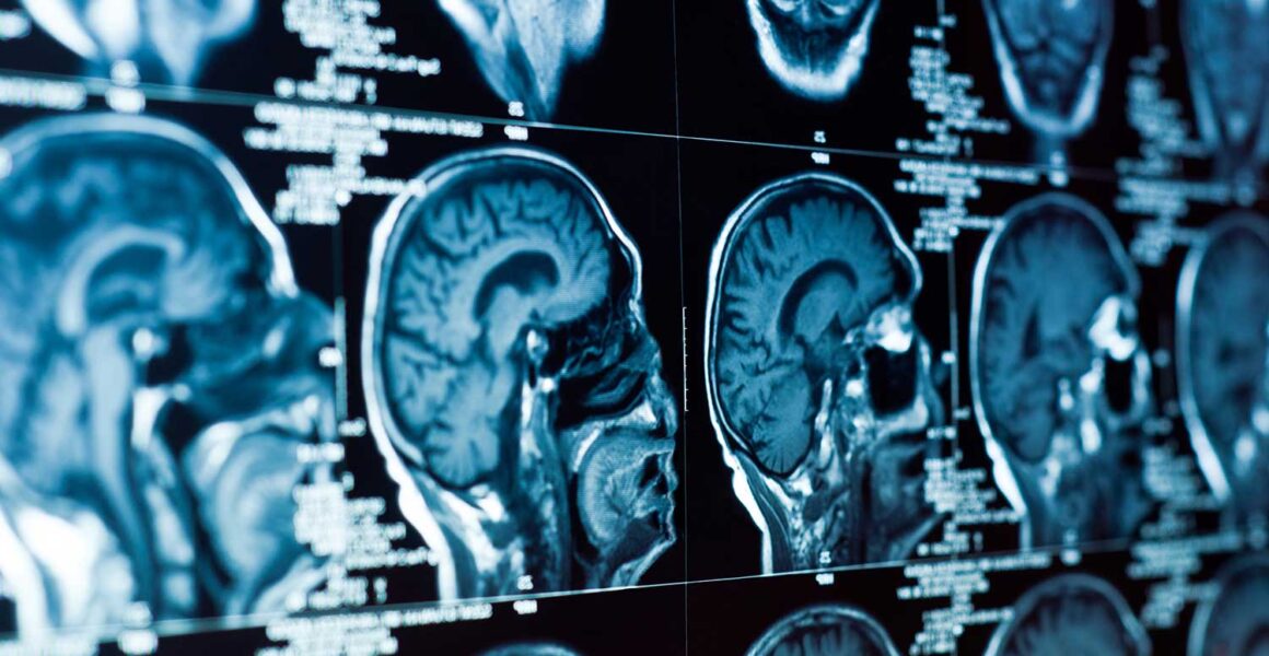 Traumatic Brain Injuries, What You Need to Know