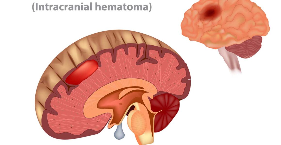 Traumatic Brain Injuries, What You Need to Know