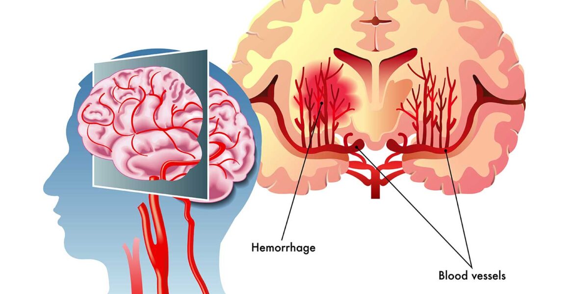 Traumatic Brain Injuries, What You Need to Know