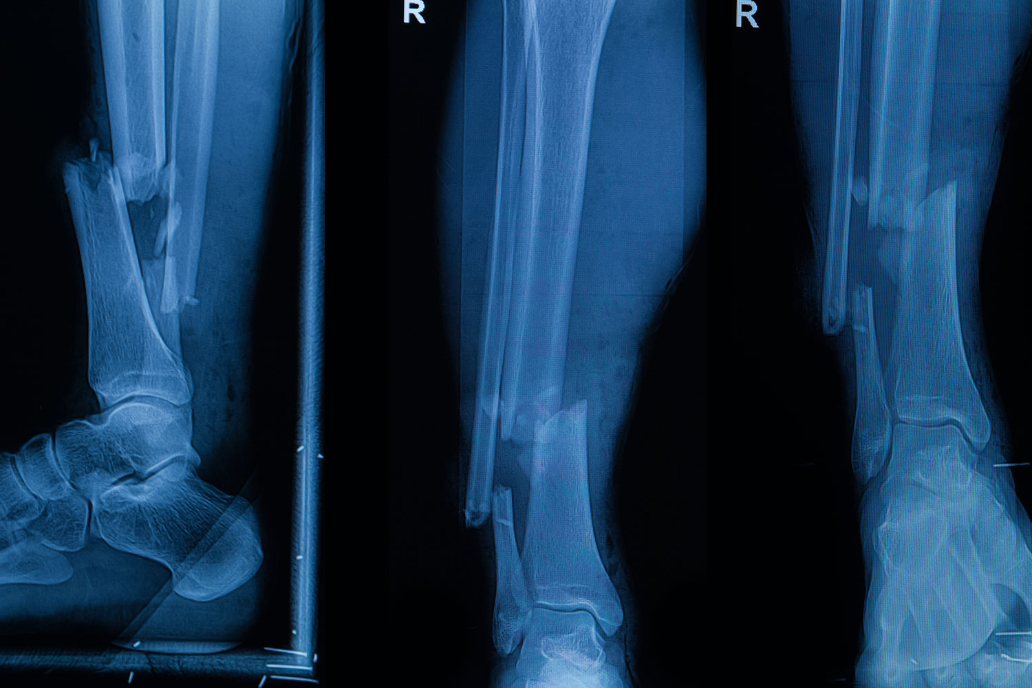 Common Skateboarding Injuries RapidCare Emergency Room 24/7