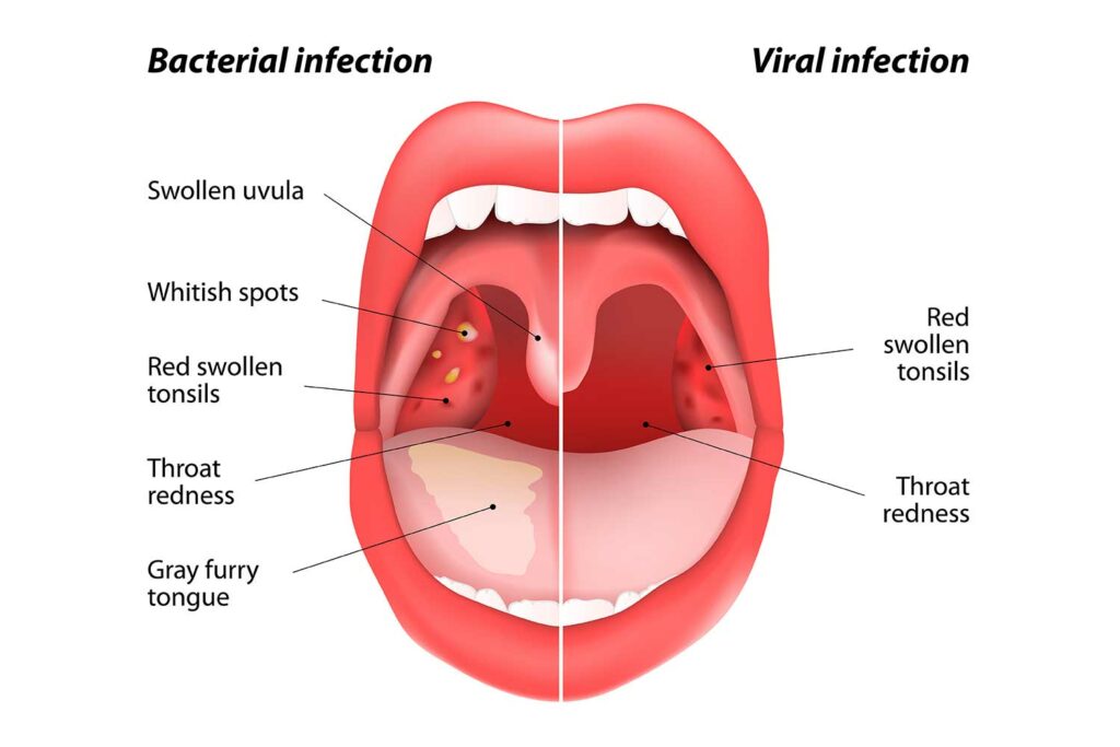 strep throat symptoms