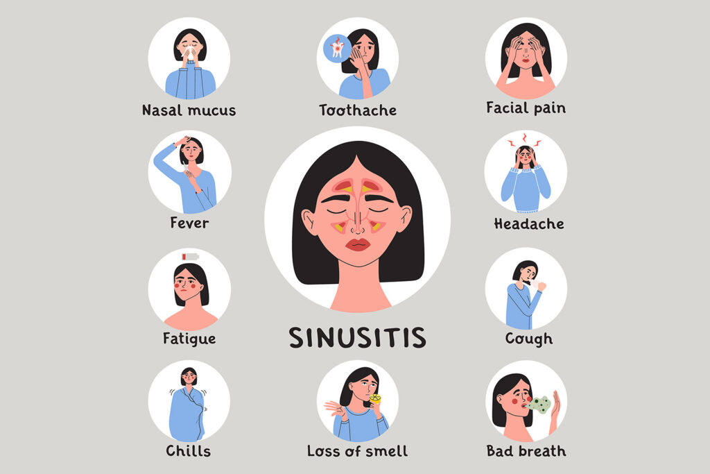 signs of sinusitis