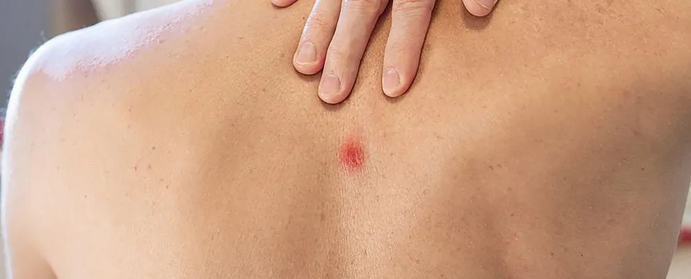image of back of a man suffering from abscess problem